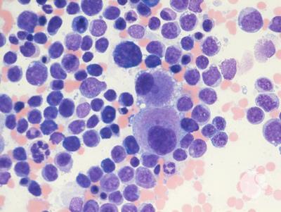 Mixed phenotype acute leukemia 3