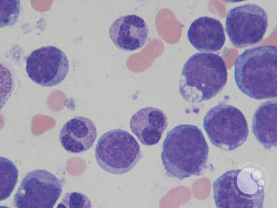 Mixed phenotype acute leukemia 4