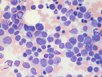 Mixed phenotype acute leukemia 5