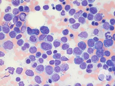 Mixed phenotype acute leukemia 5