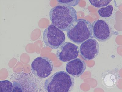 Mixed phenotype acute leukemia 6