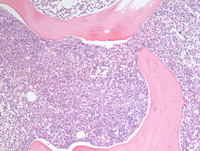 Mixed phenotype acute leukemia 7