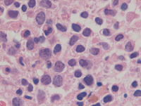 Mixed phenotype acute leukemia 8