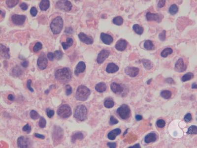 Mixed phenotype acute leukemia 8
