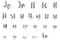 t(9;22) Karyotype