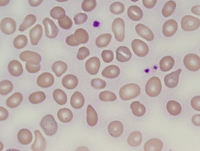 Post-polycythemic myelofibrosis, peripheral blood 1