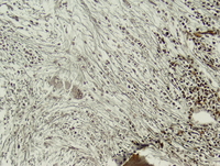 Post-polycythemic myelofibrosis, bone marrow core 5