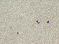 Polycythemia vera (PV), polycythemic phase, peripheral blood