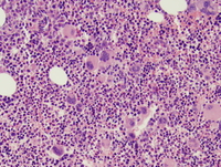 Polycythemia vera (PV), polycythemic phase, core biopsy 2