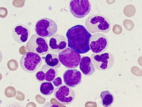 Atypical chronic myeloid leukemia, BCR-ABL1 negative