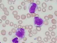 Chronic myelomonocytic leukemia -1 (CMML-1) 1