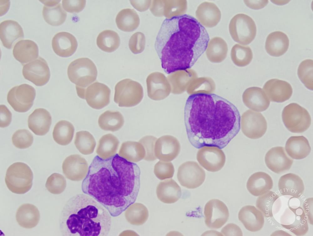 Chronic myelomonocytic leukemia 1 CMML 1 1 Chronic myelomonocytic leukemia 1 CMML 1 1