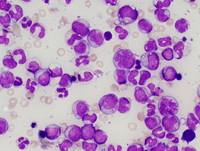 Chronic myelomonocytic leukemia -1 (CMML-1) 2