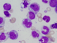 Chronic myelomonocytic leukemia -1 (CMML-1) 3