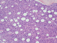 Chronic myelomonocytic leukemia -1 (CMML-1) 4