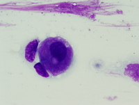 Refractory cytopenias with unilineage dysplasia 2