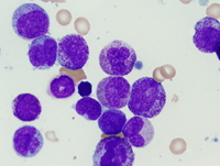 Refractory cytopenias with unilineage dysplasia 3