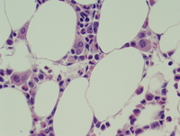 Refractory cytopenias with unilineage dysplasia 6