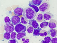 Acute myeloid leukemia with myelodysplasia-related changes 1