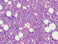 Refractory anemia with excess blasts-2 (RAEB-2) 5