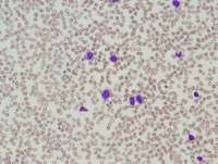 Acute myeloid leukemia with myelodysplasia-related changes 1