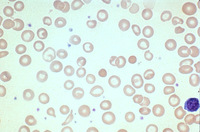 iron deficiency anemia slide