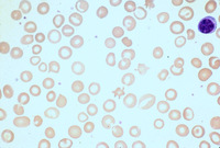 iron deficiency anemia slide