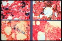 Iron Deficiency Anemia-Stains