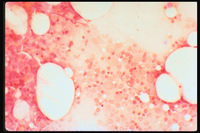 Iron Deficiency Anemia