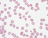 Acanthocytes