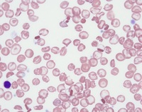 Hemoglobin C crystals and target cells