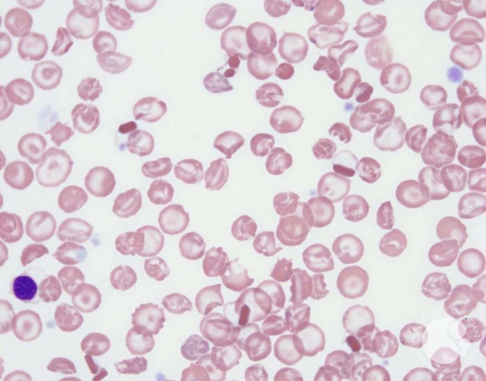 Hemoglobin C crystals and target cells