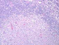 CLL with areas of necrosis