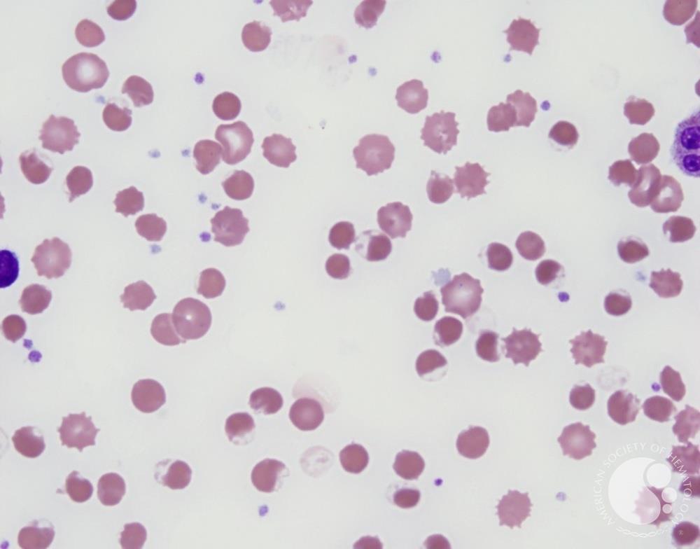 Irregularly contracted cells in oxidative hemolysis