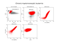 Chronic myelomonocytic leukemia, flow cytometry