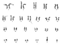 Karyotype t(6;9)