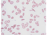 sickle cell vs normal cell