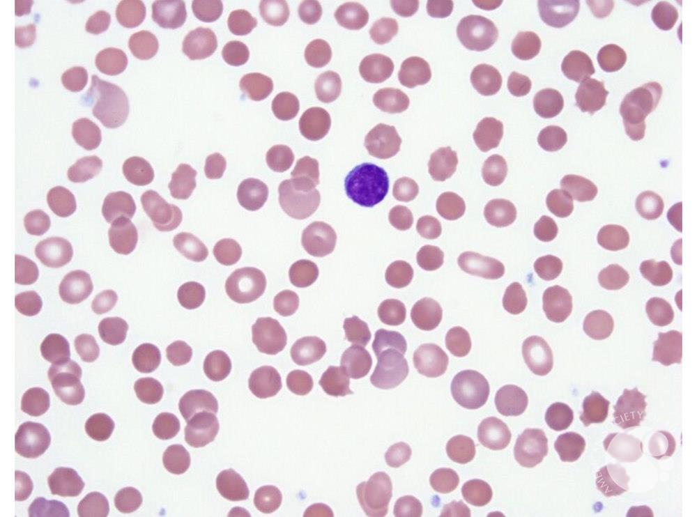 Spherocytes hereditary spherocytosis Spherocytes hereditary spherocytosis