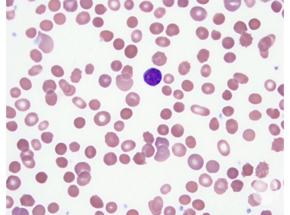 Spherocytes – hereditary spherocytosis