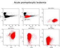 Acute promyelocytic leukemia, flow cytometry