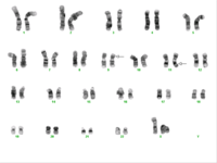 AML with t(9;11)(p22;q23)