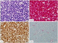 B ALL CD 34 negative Special Stains