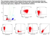 B ALL CD 34 negative Flow Cytometry