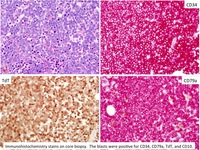 Relapsed-CD-34-ALL-Special-Stains