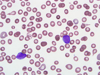 B cell ALL serial flow during rapid WBC rise