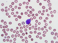 B cell ALL peripheral blood