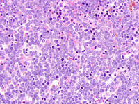 Relapsed-CD-34-ALL-Biopsy