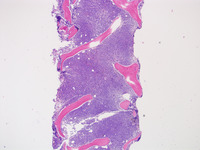 Relapsed-CD-34-ALL-Biopsy