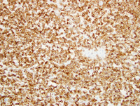 SLL with Richter's Syndrome (Hodgkin lymphoma type) 1