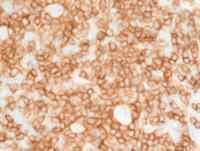 CD3-stain-highlighting-rosettes